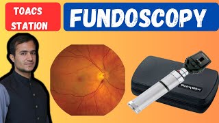 Fundoscopic examination  Fundoscopy made easy  Fundoscopy procedure  Fundoscopy eye test [upl. by Hosea]