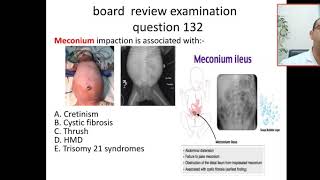 MCQ 132 whats the most common association of meconium ileuscystic fibrosissmall bowel obstruction [upl. by Horodko]