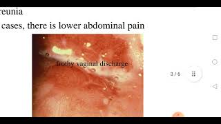 Trichomoniasis [upl. by Allicirp]