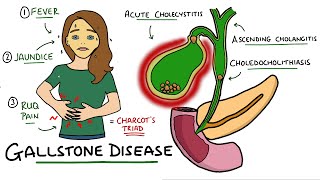 Gallstone Disease  Acute Cholecystitis vs Cholelithiasis vs Choledocholithiasis vs Cholangitis [upl. by Pike]