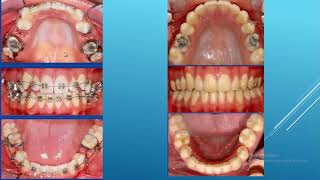 La tecnica de premolares vs tecnica de segundos molares en Ortodoncia [upl. by Dinnie]