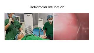 Retromolar Intubation [upl. by Onateyac140]