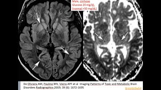 56 Hypoglycemic encephalopathy low glucose thalamic sparing insulin shock therapy [upl. by Etteragram]