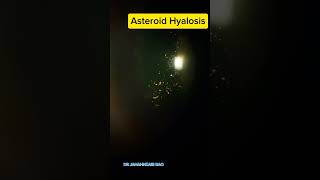 Asteroid Hyalosis eyes eyedisease [upl. by Atsirhcal]