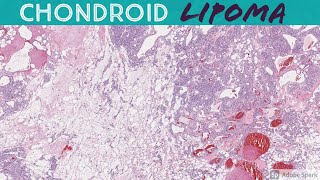 Chondroid Lipoma 5Minute Pathology Pearls [upl. by Dnalyk]