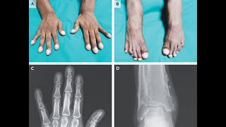 Primäre hypertrophe Osteoarthropathie [upl. by Ennoirb219]