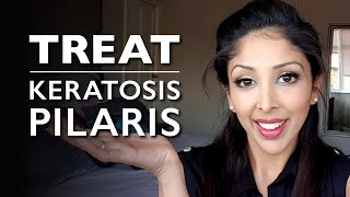 KERATOSIS PILARIS from DOCTOR V  KP Treatment chicken skin  How to treat KERATOSIS PILARIS  DR V [upl. by Beuthel550]