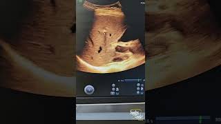 Focal Hepatic Calcifications  Ultrasound [upl. by Adias]