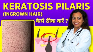 Keratosis Pilaris Treatment  Ingrown Hair on Arms Legs Face Buttocks  Home Remedies in Hindi [upl. by Kono]