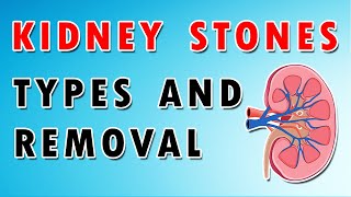 Kidney Stones  Types Diet and Removal Treatment [upl. by Lamoree]