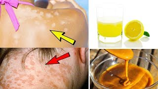 5 Effective Home Remedies For Treating Tinea Versicolor – Home Treatment Of Tinea Versicolor [upl. by Diaz750]