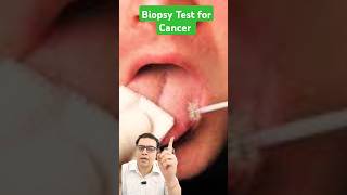 biopsy test for cancer shortvideo shortsviral shorts short [upl. by Nairda]