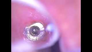 1 Dental Implant Broken Screw Retrieval Method  BioMet 3i DR GERARD CUOMO [upl. by Sucramed952]