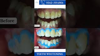 Teeth whitening before and after [upl. by Ahsela]