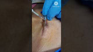 Intra tissue electrodesiccation treatment for keloid scar Contact 9700020802 [upl. by Adar504]