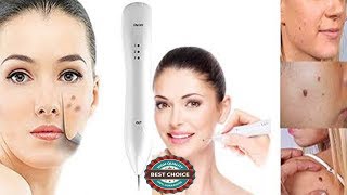 Laser Brown Spot Removal  Laser Treatment To Remove Dark Spots On Face [upl. by Gonick]