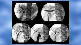 16 Radiologia interventistica delle vie biliari Paolo Fonio [upl. by Einaled454]