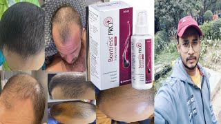 dont use bontress Pro plus scalp serum  honest review [upl. by Schmeltzer]