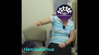 HEMIBALLISMUS [upl. by Baptista]