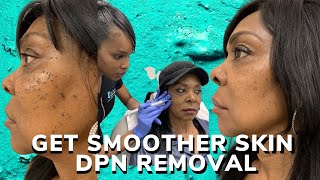 DPN removal for smoother skin [upl. by Maximilianus377]