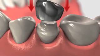 Dental Crown  Crowns And Root Canal Treatment [upl. by Samp]