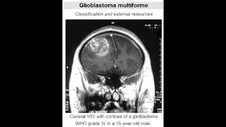 Glioblastoma Multiforme grade IV astrocytoma  Most Common Primary Brain Tumor [upl. by Dlanor813]