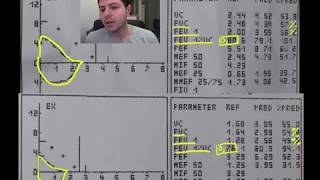 Spirometrie 5  exemple DVR disfunctie ventilatorie restrictiva [upl. by Ai]