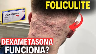 Dexametasona é eficaz para Foliculite [upl. by Elrod927]