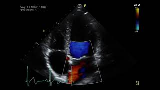 Pulmonary Stenosis [upl. by Junji165]