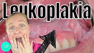 Leukoplakia  Causes Diagnosis amp Treatment WHAT CAUSES LEUKOPLAKIA [upl. by Harrus541]