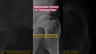 Avascular Necrosis of the Femoral Head “Crescent Sign” xray radiology [upl. by Madda195]