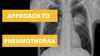 Approach to Pneumothorax  How to Read a Chest X Ray [upl. by Dnomsaj]