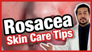 5 Quick Ways to Get Rid of Rosacea FAST  How to Get Rid of Rosacea 2021 [upl. by Cirederf]