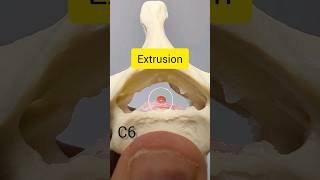 Cervical Disc Herniation Rupture of Cervical Disc Model [upl. by Ihsakat]