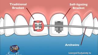 Vincent Team Orthodontics SelfLigating Braces [upl. by Assirat715]