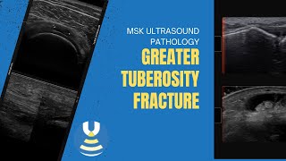 Greater tuberosity fracture on ultrasound [upl. by Bank]