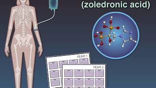 Zoledronate in Osteopenia [upl. by Hopfinger363]