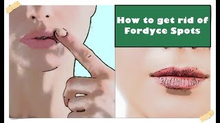 Fordyce Spots on Lips – Treatment How to get rid of them [upl. by Lennahc420]