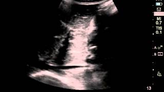 ultrasound of total IVC collapse [upl. by Llewxam]