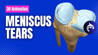 Meniscus Tears  Condition Treatment and Surgery  3D Animation [upl. by Adyahs]