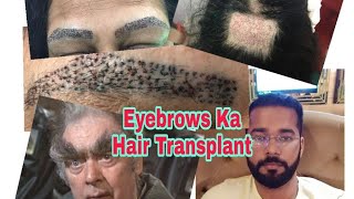 The Most Costly Hair Transplant is Eyebrow Transplant  Approx 700 Rs per Graft [upl. by Clayborne58]