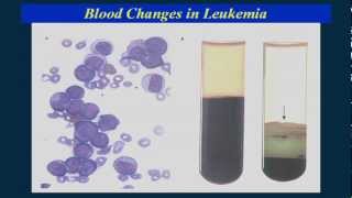 Finding the causes of leukemia [upl. by Nnylatsirk753]