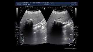 Calcified Hepatic Mass [upl. by Orazal]