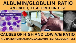 ALBUMIN TO GLOBULIN RATIOAG RATIO TESTHIGH AND LOW AG RATIOAG RATIO INLIVER AND KIDNEY PROBLEM [upl. by Llywellyn829]