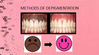 Gingival Melanin Depigmentation  Case Report [upl. by Airotna809]