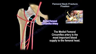 Femoral Neck Fracture Anatomy  Everything You Need To Know  Dr Nabil Ebraheim [upl. by Glori443]