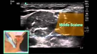 How To UltrasoundGuided Interscalene Block Scanning Technique Video [upl. by Aniara360]