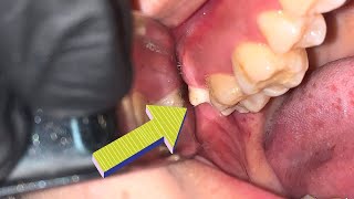 Removal of Impacted Maxillary third Molar  Geraham Bungsu  Dentist  Dokter Gigi Tri Putra [upl. by Terraj]