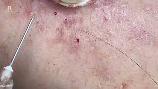 Big Cystic Acne Blackheads Extraction Blackheads amp Milia Whiteheads Removal Pimple Popping [upl. by Ynamad696]