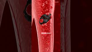 Atrial Fibrillation Explained  ECG  Afib Treatment  Management [upl. by Mcintosh870]